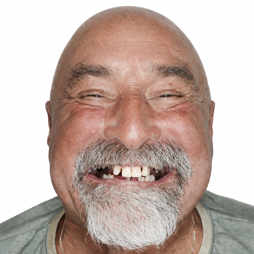 smile makeover before