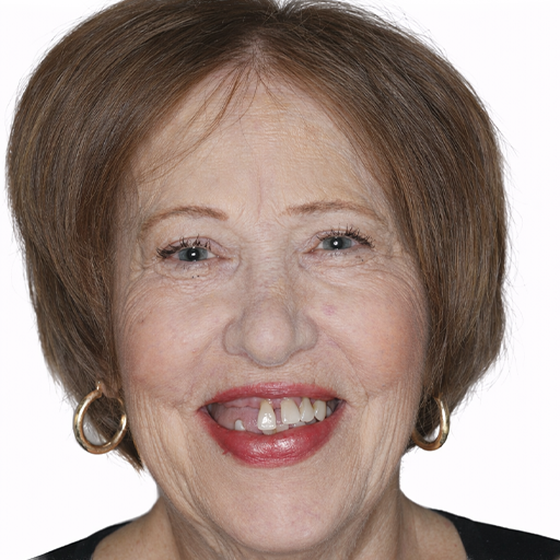 smile makeover before