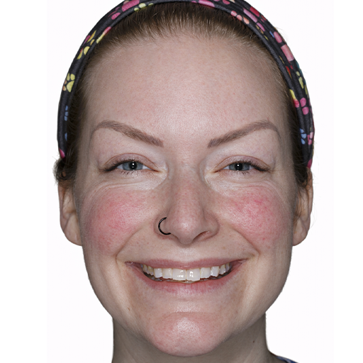 Smile Makeover