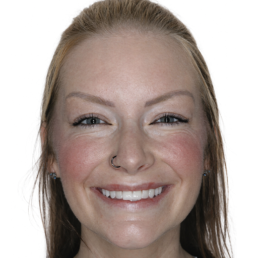 Smile Makeover After