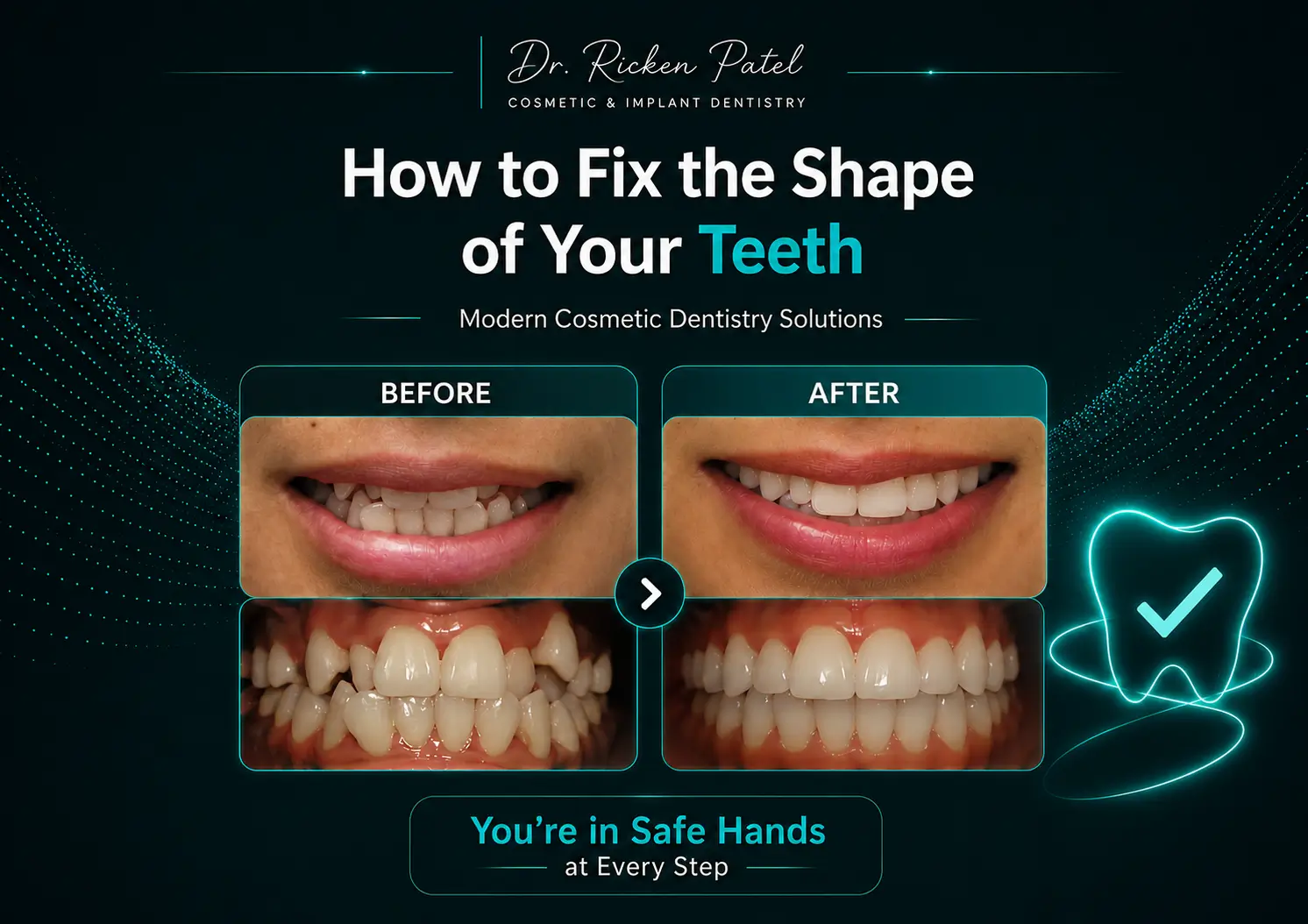 How to Fix the Shape of Your Teeth How to Fix the Shape of Your Teeth