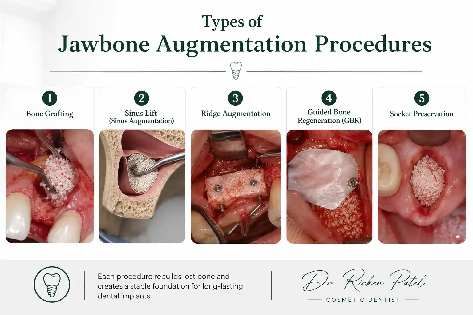 Jawbone Augmentation Before Implants Jawbone Augmentation Before Implants